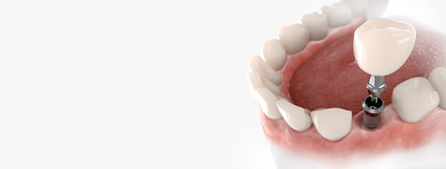 O Sorriso Novo que Você Merece